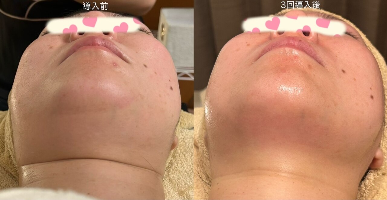 レモンボトル4CCで脂肪分解・小顔リフト