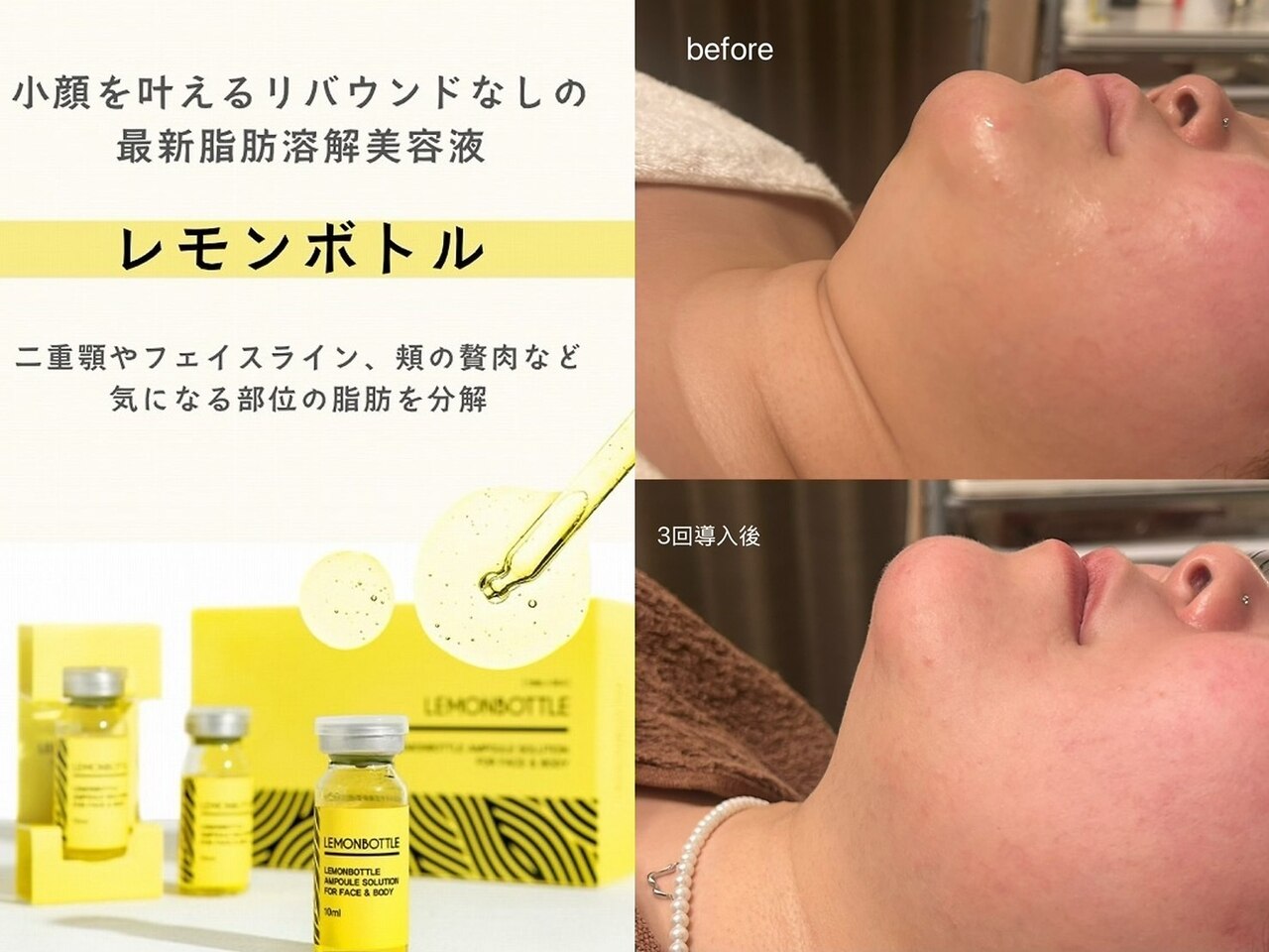 レモンボトル4CC×ハイパーW痩身：夏までに変わる集中フルコース